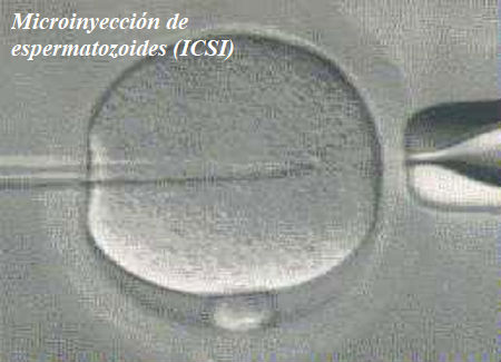 Microinyección de espermatozoides (ICSI)