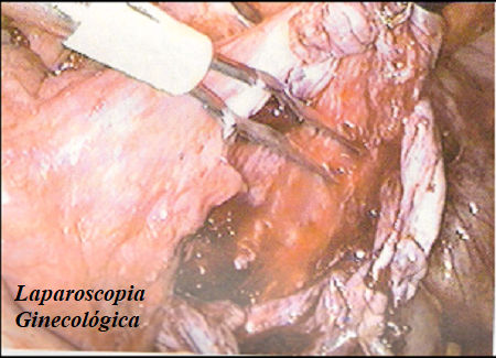 Laparoscopia Ginecológica